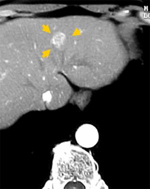 肝がんのCT像（黄色矢印）