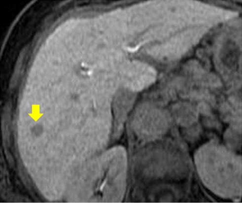 2017年度　（図5：肝がんのMRI像　黄色矢印,Gd-EOB造影MRI 肝細胞相）