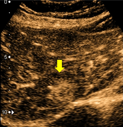 2017年度肝がん（図2：肝がんの造影超音波検査像　黄色矢印、ソナゾイド血管相）